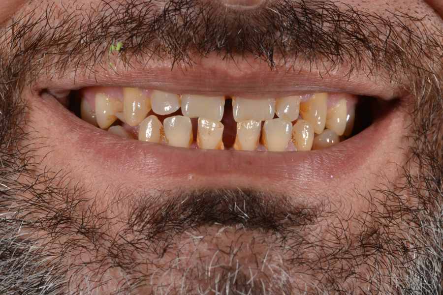 قبل تغير لون و شكل الأسنان لإعادة تأهيل الابتسامة